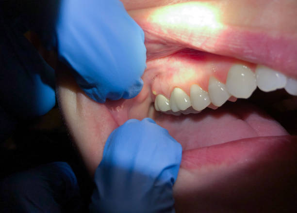 Best Emergency Treatment for Dental Infections or Abscesses in Orange, CA